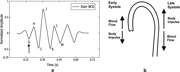 Chart and pictogram to display the BCG waveforms